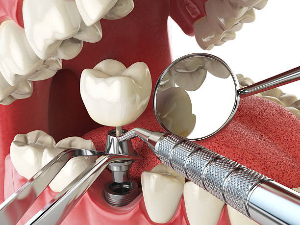 Best Emergency Tooth Extraction in Blackwells Mills, NJ